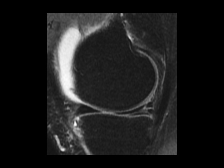 Figure 5 for case anterior cruciate ligament ( RID2781 )